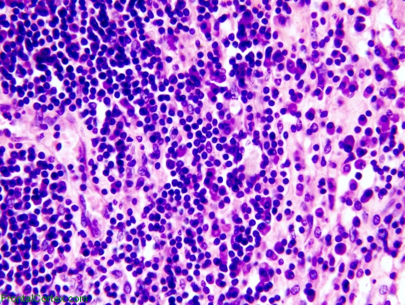 Gummatous neurosyphilis, high power H&E stained section
