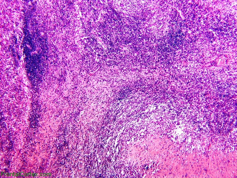 Gummatous neurosyphilis, low power H&E stained section