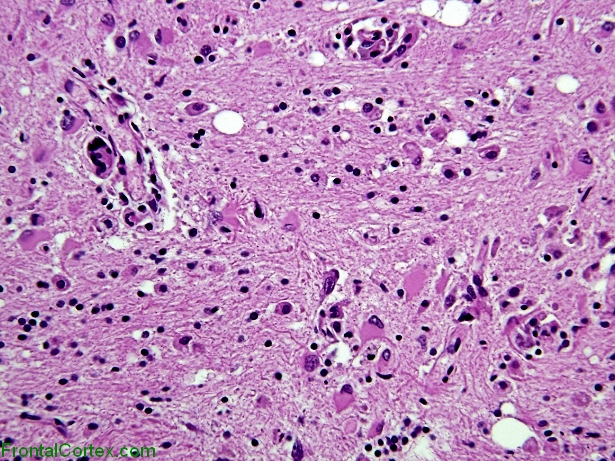 HIV encephalopathy, H&E stained section