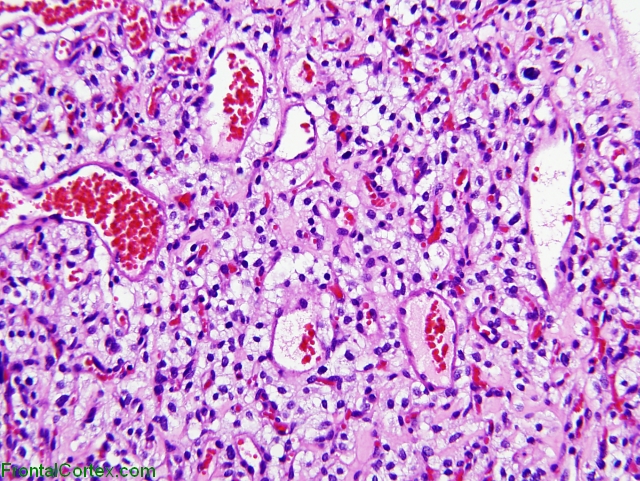Hemangioblastoma,  H&E stain x 200