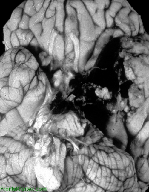 Herpes simplex encephalitis, ventral surface of brain.