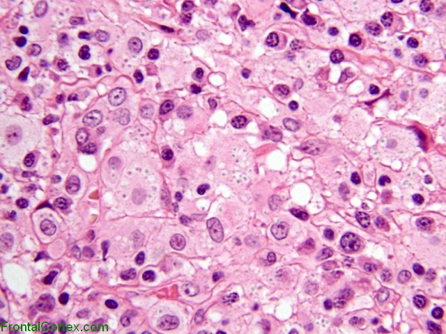 Histoplasmoma, H&E stained section, high-power.