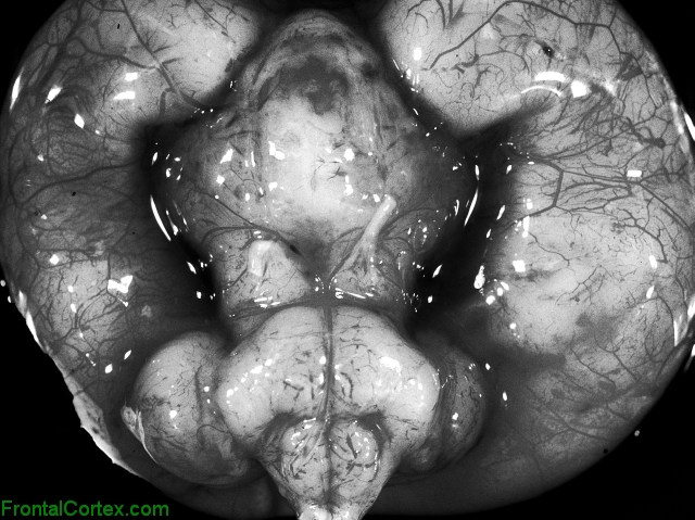Holoprosencephaly, ventral surface of brain.