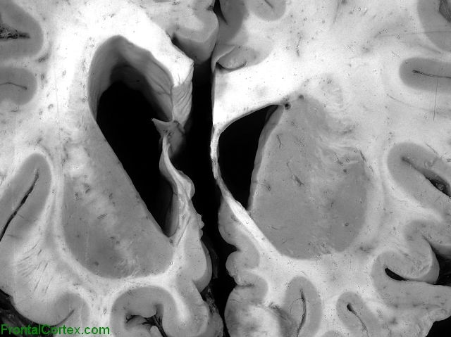 Huntington disease, coronal section through basal ganglia (control brain on right).