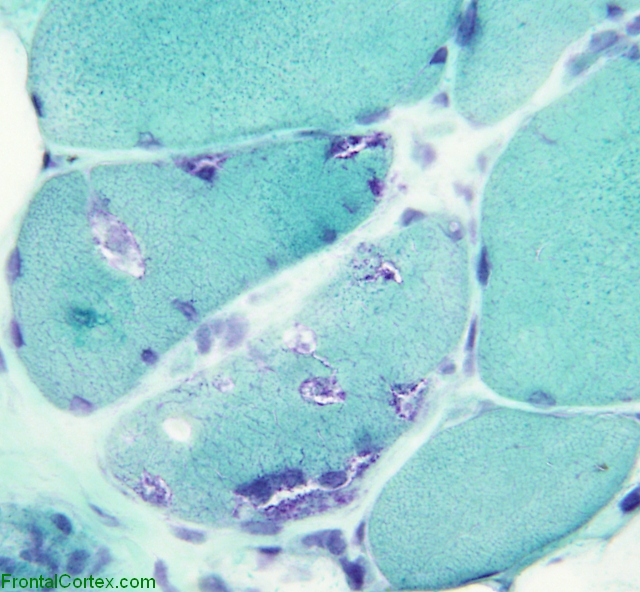 Inclusion body myositis, Gomori trichrome stained frozen muscle x 200