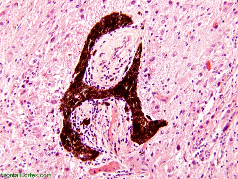 Immature Teratoma of pineal region demonstrating primitive retinal differentiation, H&E stain x 200