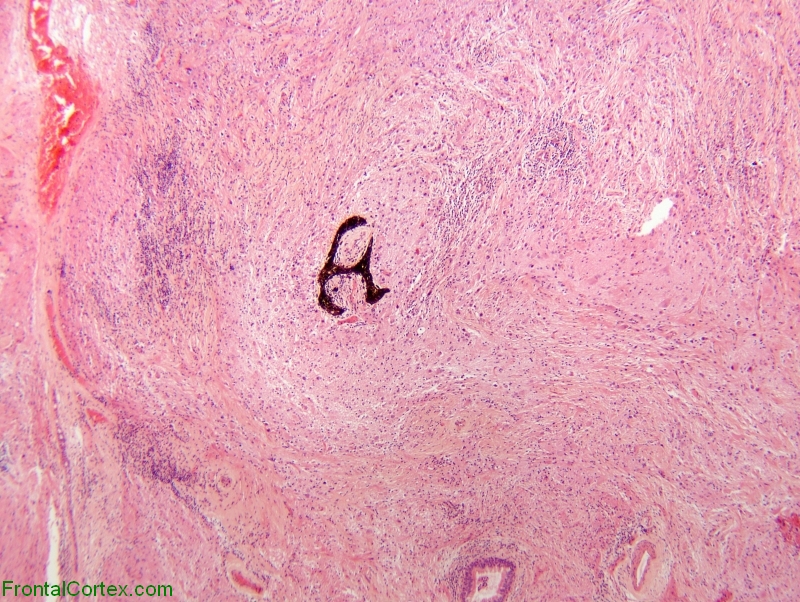 Immature Teratoma  of pineal region, H&E stain x 40