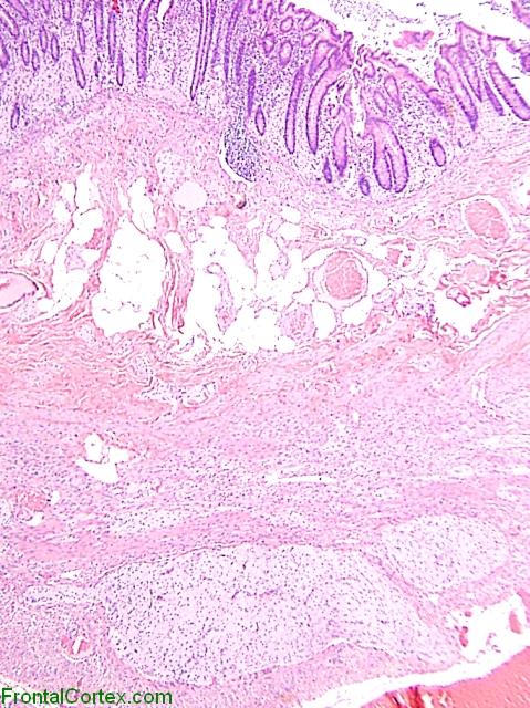 Intestinal Ganglioneuromatosis H