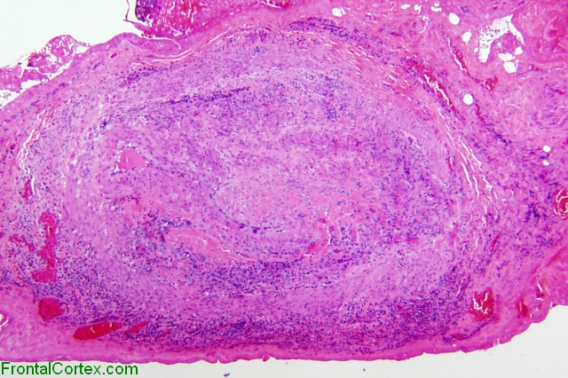 Juvenile temporal arteritis with eosinophilia, H&E stained section x 20