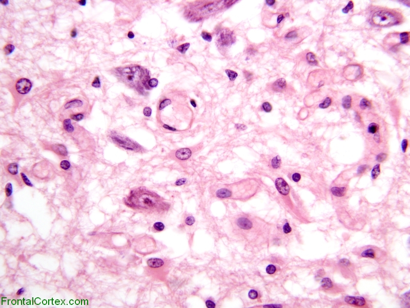 Kearns-Sayre syndrome, high power H&E stained section of substantia nigra