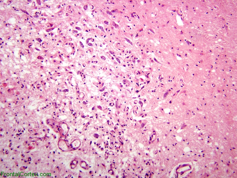 Kearns-Sayre syndrome, H&E stain section of substantia nigra x 100