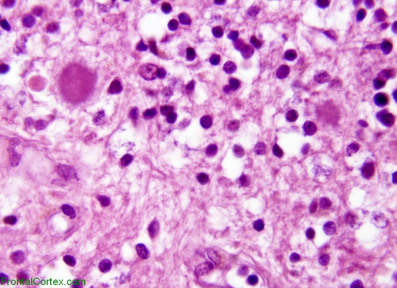 Kuru plaques, granular cell layer of cerebellum, H&E stain x 400