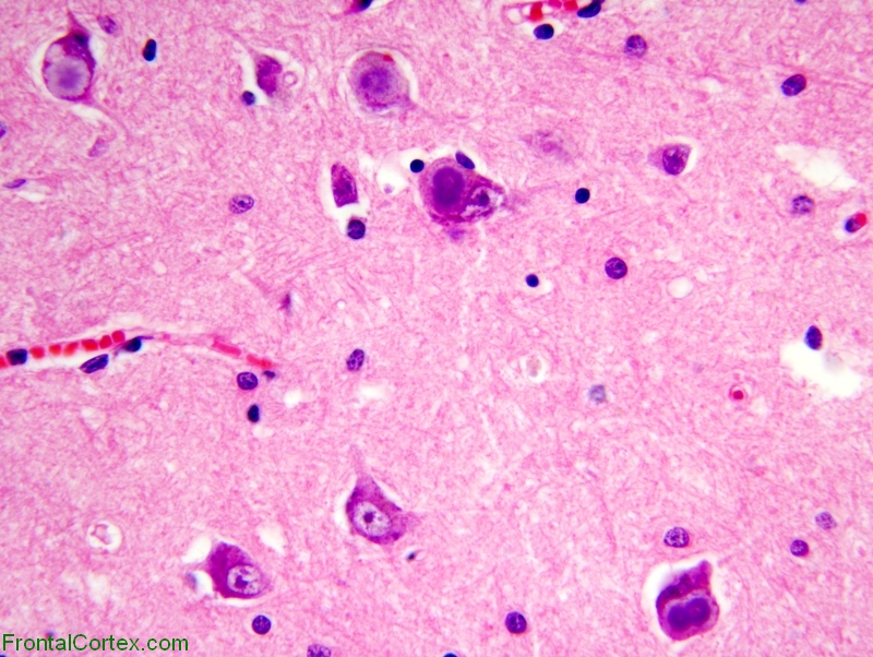 Familial myoclonic epilepsy, high power H&E stained section of brain