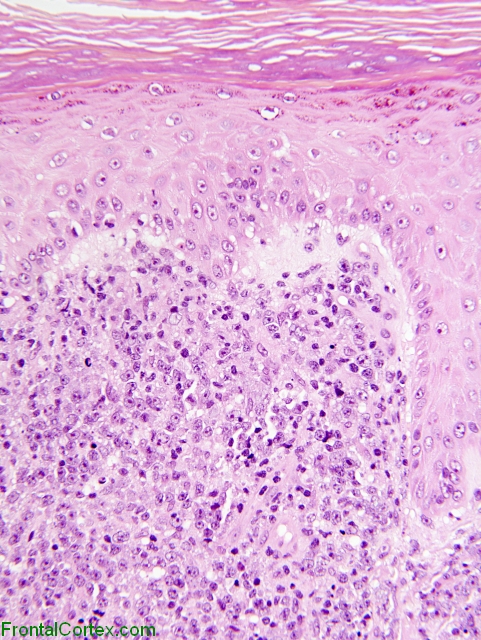 Large B-cell Lymphoma Leg, H&E stained section