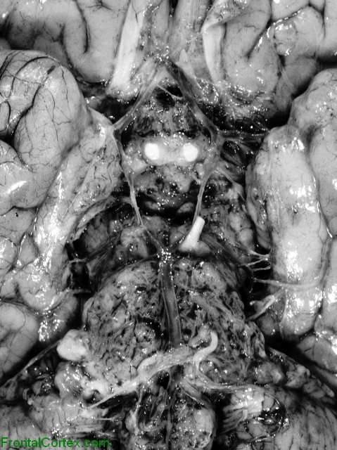 Leptomeningeal carcinomatosis, ventral surface of brain.