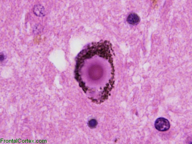 Lewy Body, substantia nigra neuron x 400