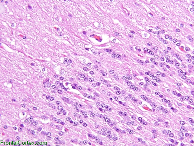 Lhermitte-Duclos disease, H&E stained section