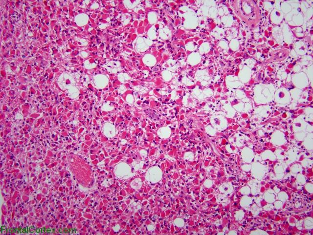 Lipoastrocytoma, H&E stain x100