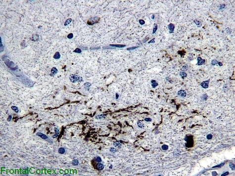 MSA Inferior Olive Synuclein High Power