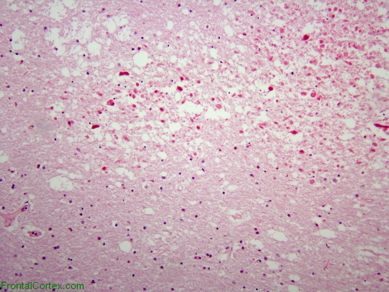 Methotrexate neurotoxicity, H&E stained section x 100
