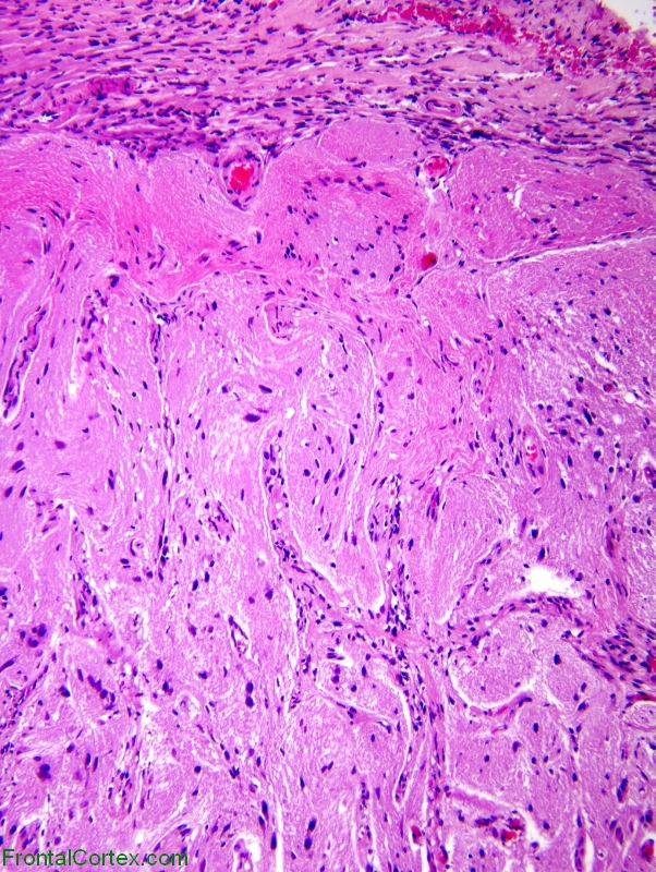 Meningioangiomatosis, low power H&E stained section of cerebral cortex and leptomeninges