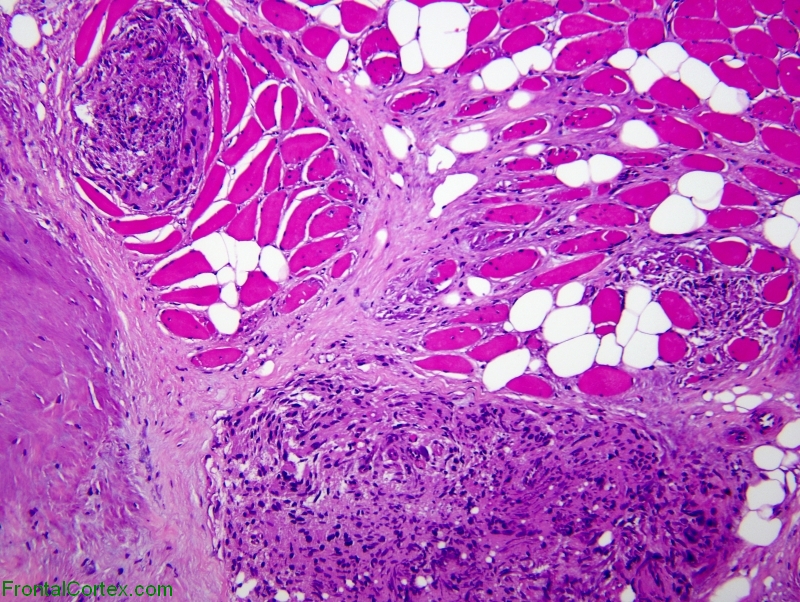 Muscle invasion by meningioma, H&E stained section