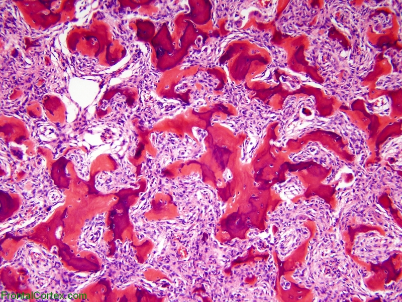 Metapastic meningioma with bone formation, H&E stain.