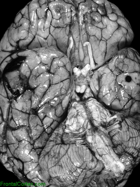 Metastatic malignant melanoma, ventral surface of brain.