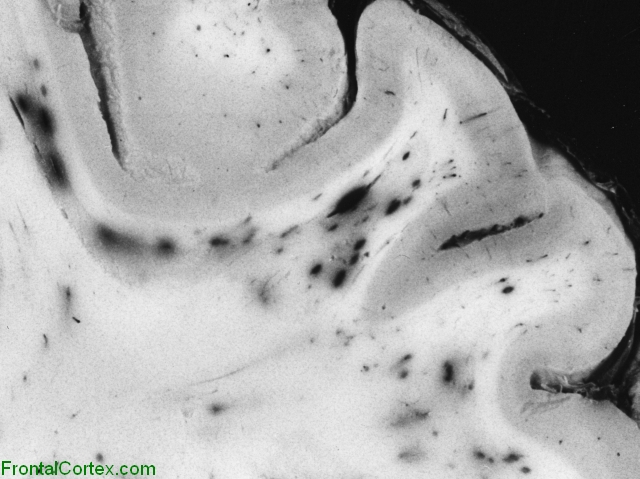Acute methyl bromide toxicity, coronal section of brain, close up