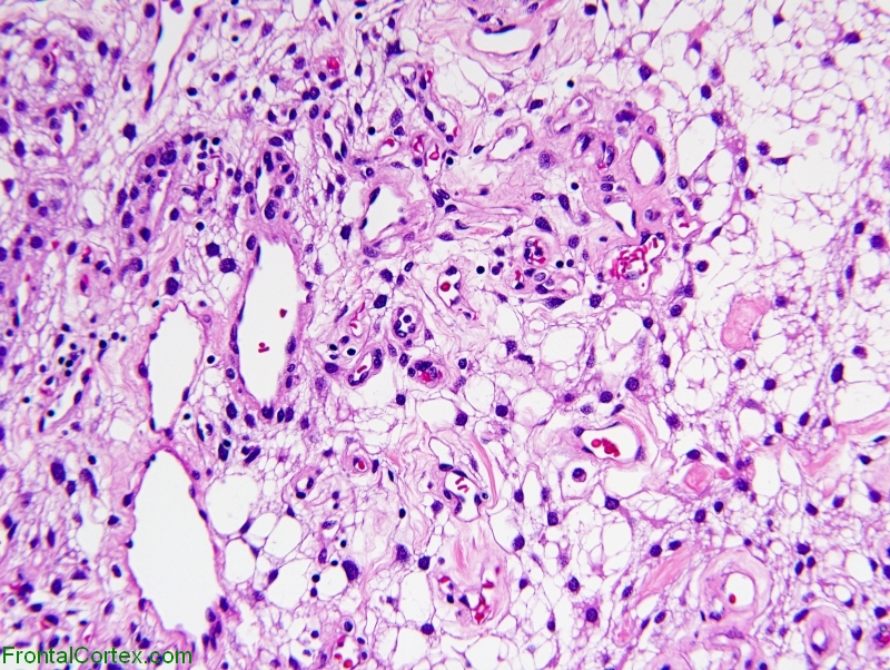 Microcystic meningioma, high power H&E stained section