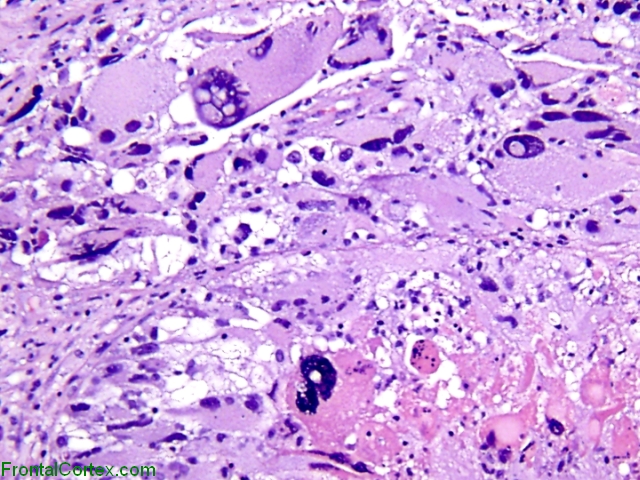 Monstrocellular Glioblastoma