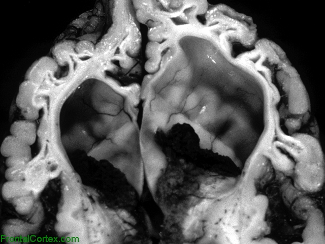 Multicystic Encephalopathy, horizontal  section