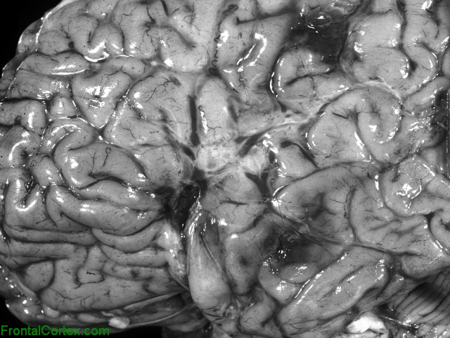 Multiple brain abscesses, lateral surface of cerebrum