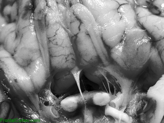Neurocutaneous Melanosis Ventral Close Up