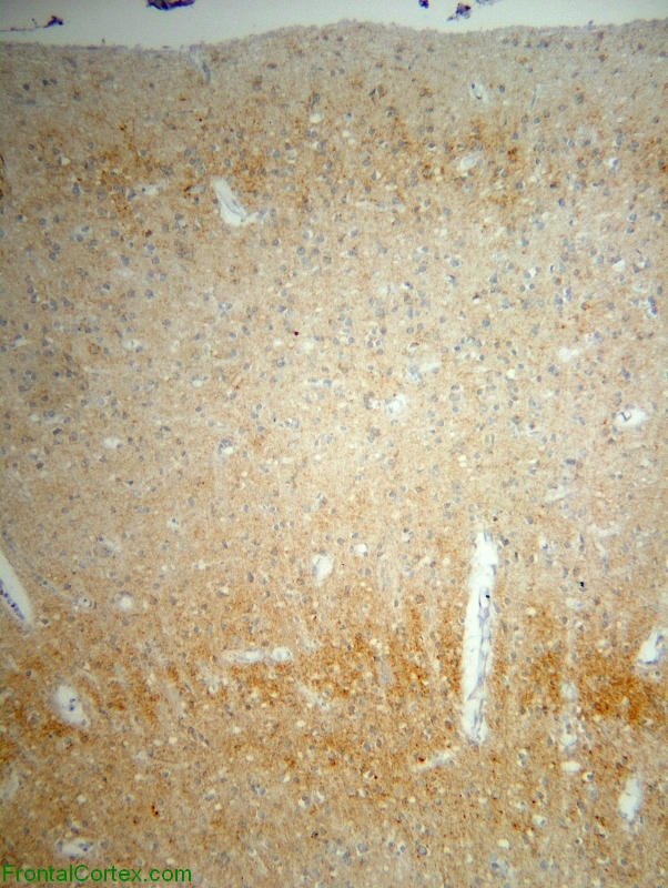 Sporadic JCD associated with type II prion, occipital neocortex, 3F4 immunohistochemical staining.