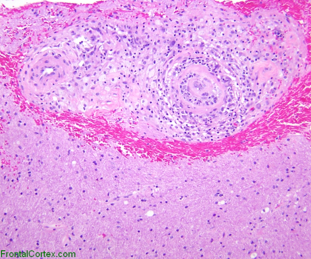 Primary angiitis of the nervous system, low power H&E stained section including leptomeninges