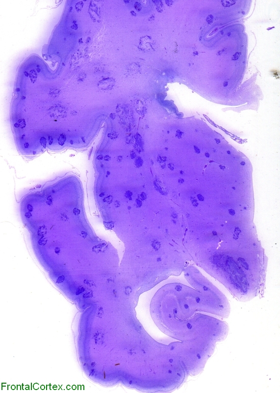 Neonatal candidiasis, PAS stain whole mount section