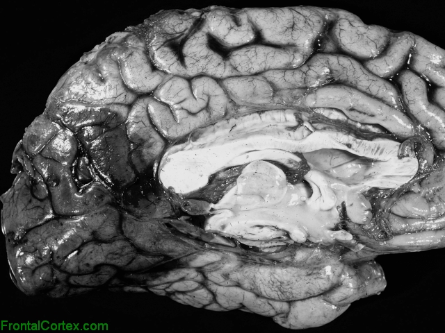 Posterior cerebral artery infarct, mid sagittal section of cerebral hemisphere
