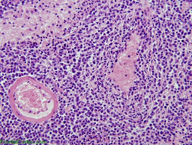 Primary central nervous system lymphoma, high power H&E stain