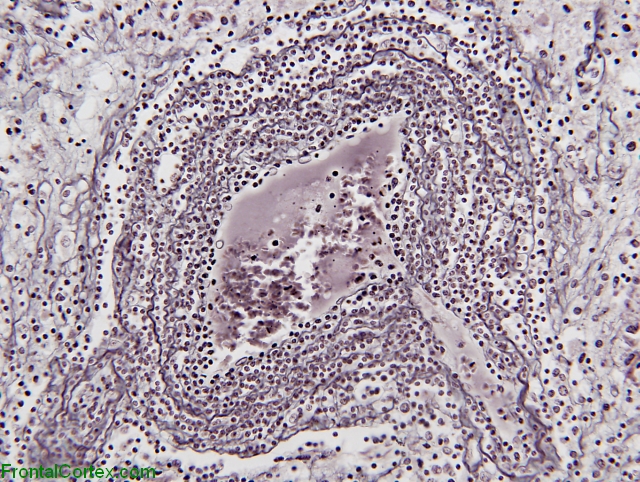 Primary central nervous system lymphoma, reticulin histochemistry x 400
