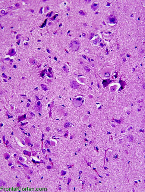  Focal cortical dysplasia, Palmini 2b, high power H&E stained section