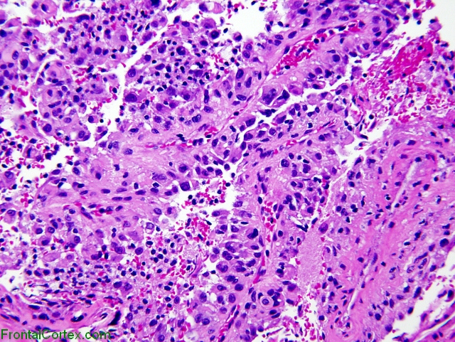 Papillary meningioma, low power H&E stained section