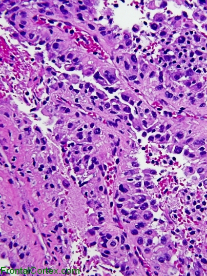 Papillary meningioma, high power H&E stained section.