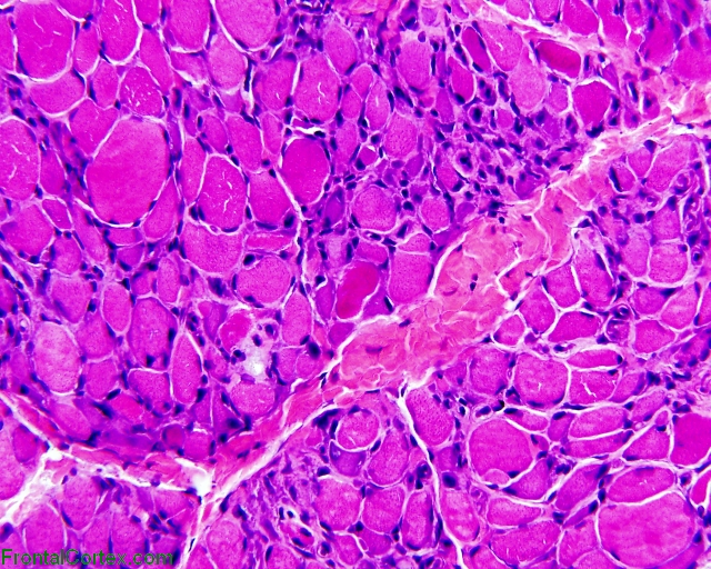 Dermatomyositis, H&E stained section of frozen skeletal muscle x 100
