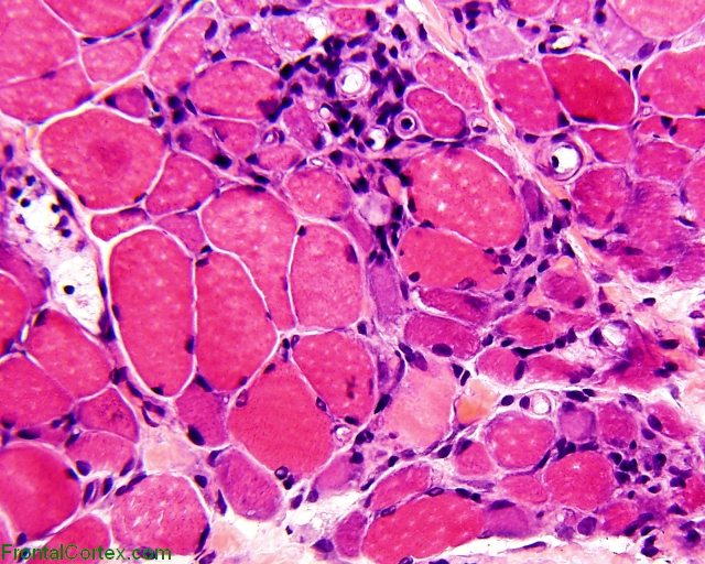 Paraneoplastic myositis, H&E stained section