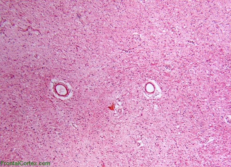 Pelizaus-Merzbacher disease, H&E stained section of white matter