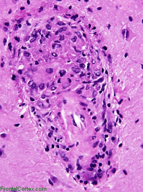 Perivascular granulomatous inflammation in a patient with neurosarcoidosis