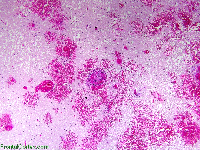 Phaeomycosis, low power H&E stained section.