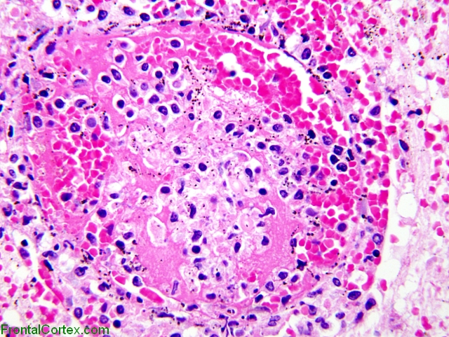 Phaeomycosis, high power H&E stained section