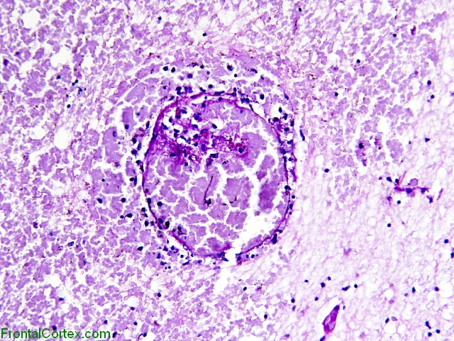 Phaeomycosis, PAS stained section x100